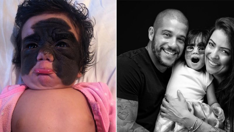 See how the baby whose birthmark resembled Batman’s mask looks like today